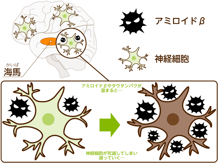 アルツハイマー型認知症になる脳の原因についての図